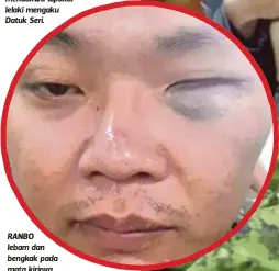  ??  ?? DUA daripada tiga anggota Rela yang mendakwa dipukul lelaki mengaku Datuk Seri. RANBO lebam dan bengkak pada mata kirinya.