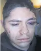  ??  ?? This photo of Michael Deherrera at Swedish Hospital after being beaten by Denver Police officers, was supplied by Deherrera's father, Michael Deherrera.