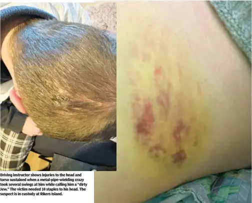  ?? ?? Driving instructor shows injuries to the head and torso sustained when a metal-pipe-wielding crazy took several swings at him while calling him a “dirty Jew.” The victim needed 10 staples to his head. The suspect is in custody at Rikers Island.