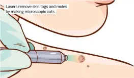  ?? ?? Lasers remove skin tags and moles by making microscopi­c cuts