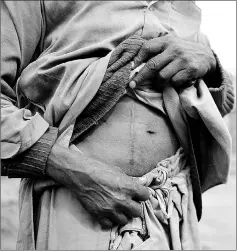  ??  ?? Maqsood Ahmed, who sold one of his kidneys, displays a scar in Bhalwal in Sargodha District.