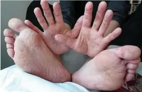  ?? (Foto hiasan) ?? Hanya 4,239 kes jangkitan penyakit tangan, kaki dan mulut direkod tahun lalu.
