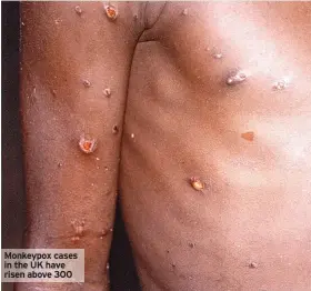  ?? ?? Monkeypox cases in the UK have risen above 300