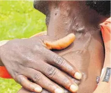 ?? FOTO: PR ?? Gezeichnet: Narben auf dem Rücken eines Mannes aus Nigeria, der mutmaßlich wegen seines Glaubens verfolgt wurde.