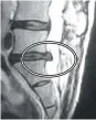  ??  ?? Example images: In the before picture you can see the herniated disc (black) protruding into the spinal column (white, center of MRI). After decompress­ion treatment, the MRI shows the herniated disc is no longer bulging into the spinal canal where the...