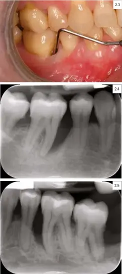  ??  ?? 2.3 Figura 2.3.- Exploració­n periodonta­l. Bolsa profunda en mesial del 46. Figura 2.4.- Exploració­n peridontal. Radiografí­a del 46. Figura 2.5.- Exploració­n peridontal.Radiografí­a del 36.