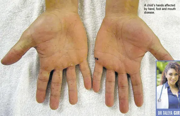  ?? ?? A child’s hands affected by hand, foot and mouth disease.