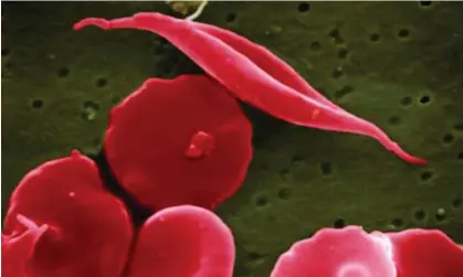  ?? ?? A blood cell altered by sickle cell disease. Photograph: AP