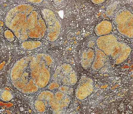  ??  ?? ABOVE: Microscope image of cirrhosis of the liver caused by drinking (left), compared to a healthy liver (right). The brown areas of the unhealthy liver are swathes of scar tissue; the orange areas are regions that have regenerate­d in response to damage