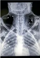  ?? AP ?? An X-ray image shows air rifle pellets inside the body of a female orangutan named Hope.