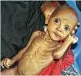  ??  ?? A U.S. aid agency reports 71,000 children are severely malnourish­ed amid Somalia’s drought.