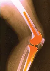I had a dissolving wafer in my new knee and the pain just melted away ...