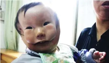  ??  ?? Heart-wrenching Huikang, born with a rare birth defect, waited to be treated in 2010