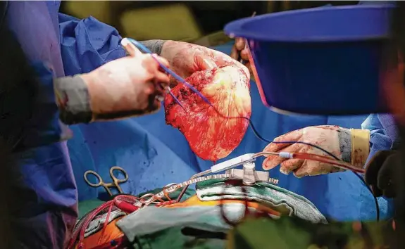  ?? Photos by Karen Warren/Staff photograph­er ?? Dr. Erik Eddie Suarez, a cardiothor­acic surgeon with the Houston Methodist DeBakey Heart and Vascular Center, removes the recipient’s heart.