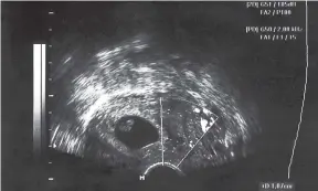  ??  ?? Ultrasound portrait of a foetus.