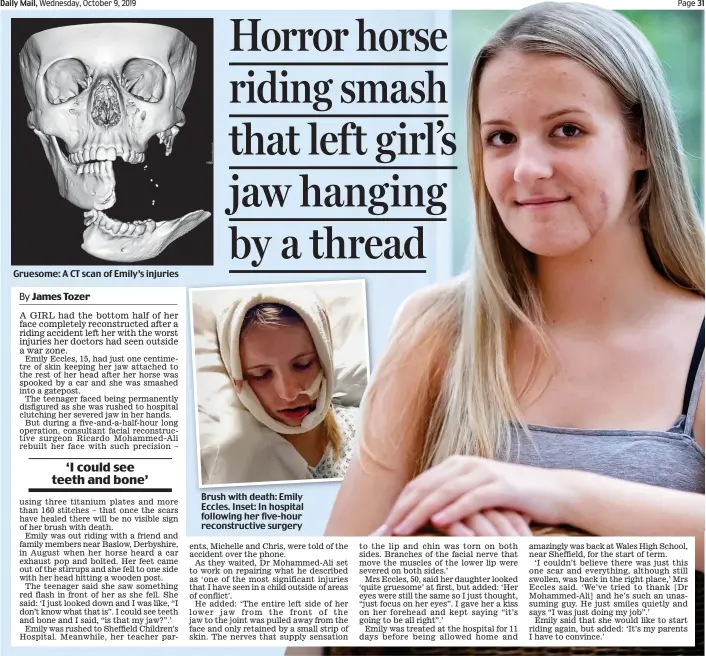  ??  ?? Gruesome: A CT scan of Emily’s injuries Brush Br h with ith death: d th Emily Emil Eccles. Inset: In hospital following her five-hour reconstruc­tive surgery