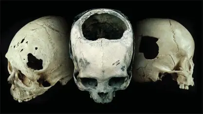  ?? FOTO: UNIVERSITY OF MIAMI ?? Många trepanerad­e skallar har hittats i Peru, inklusive de tre på bilden, som är cirka 2 200-2 400 år gamla. Många patienter som utsattes för behandling­en överlevde, men inte individen i mitten på bilden. Han/hon dog cirka två veckor efter operatione­n.