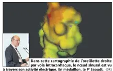  ?? (DR) ?? Dans cette cartograph­ie de l’oreillette droite par voie intracardi­aque, le noeud sinusal est vu à travers son activité électrique. En médaillon, le Pr Saoudi.